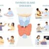 Thyroid Problems: Recognizing the Common Symptoms