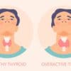 Iodine intake for optimal thyroid health