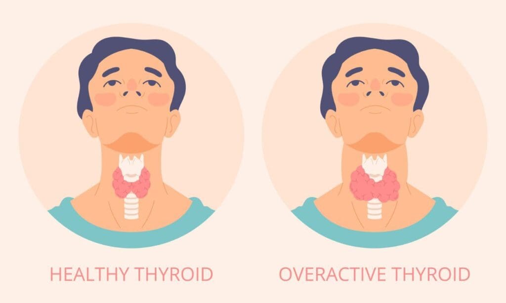 How much iodine do I need for thyroid health? FITPAA