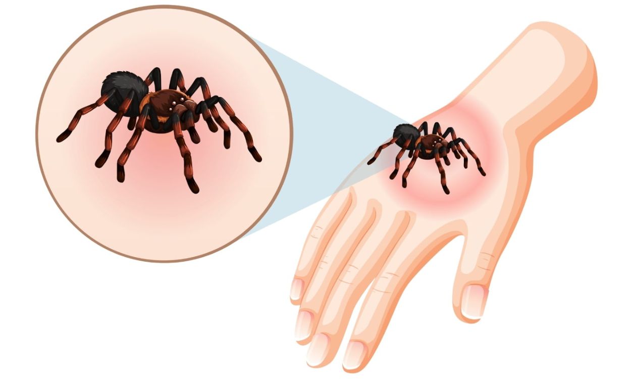 Spider Bites, treatment symptoms and first aid