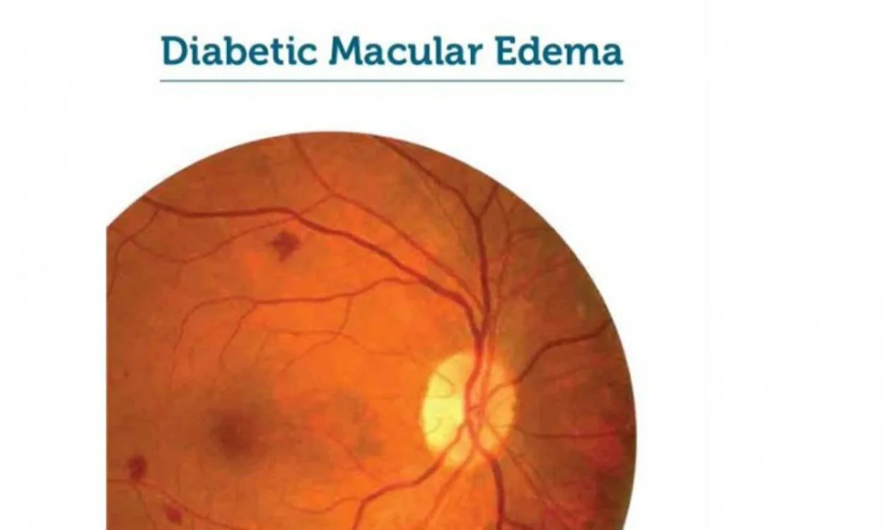 diabetic macular edema