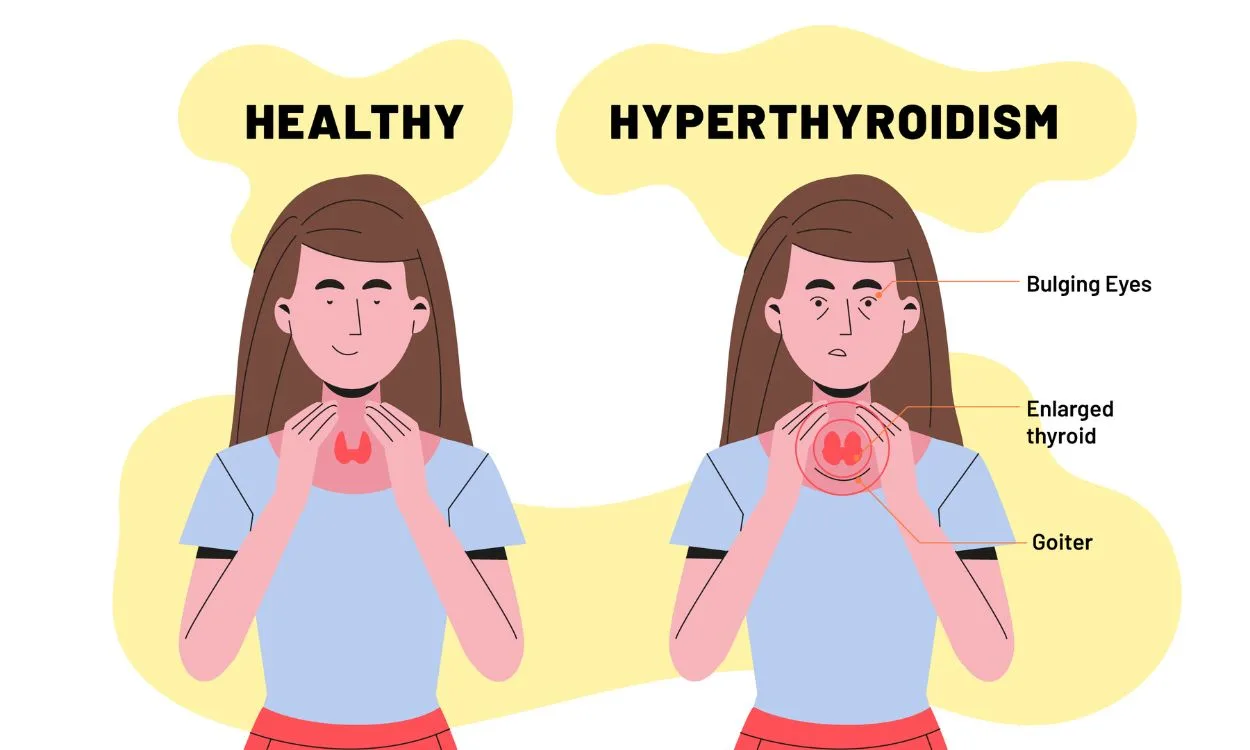 Thyroid