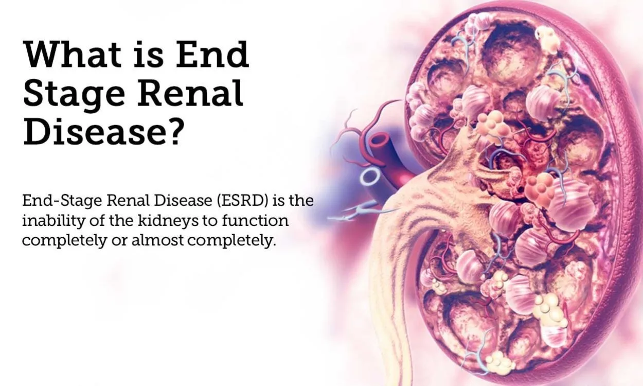 What Is End stage Renal Disease ESRD FITPAA